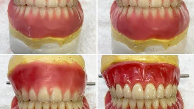 دندان مصنوعی یا پروتز متحرک دندان