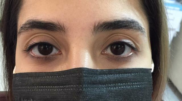 ترمیم و تقویت ابرو با جدید ترین روش