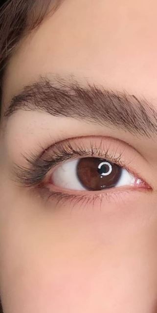 ترمیم و تقویت ابرو در تهران