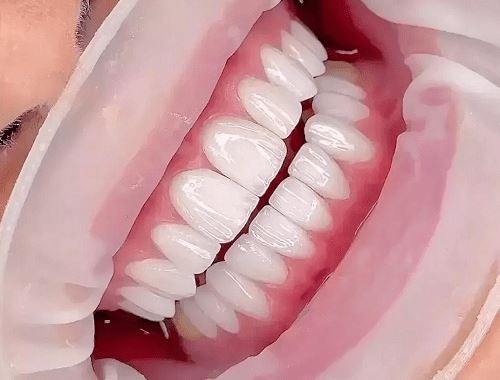 کامپوزیت لب شیشه ای