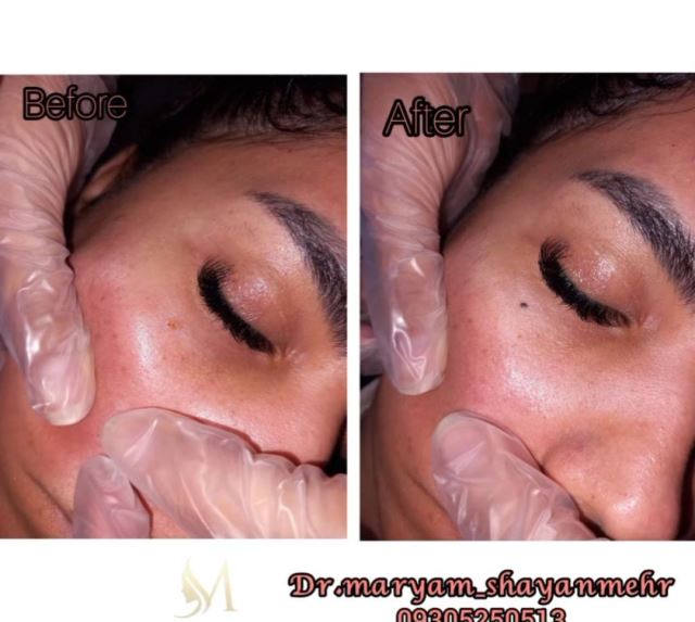 برداشتن خال