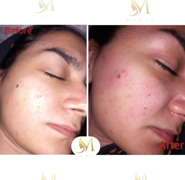 برداشتن خال و زگیل