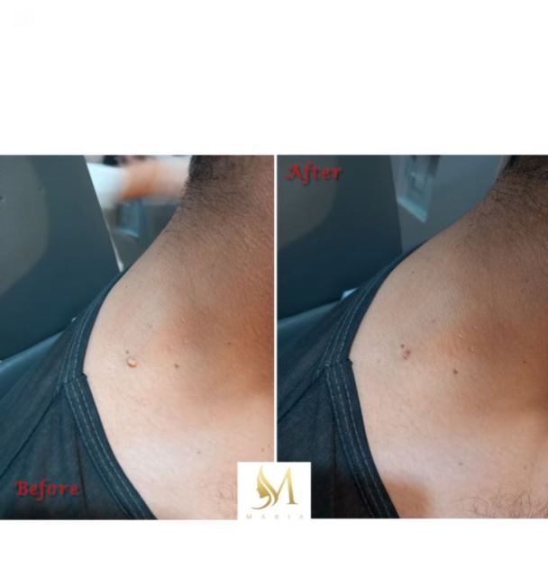 برداشتن خال و زگیل