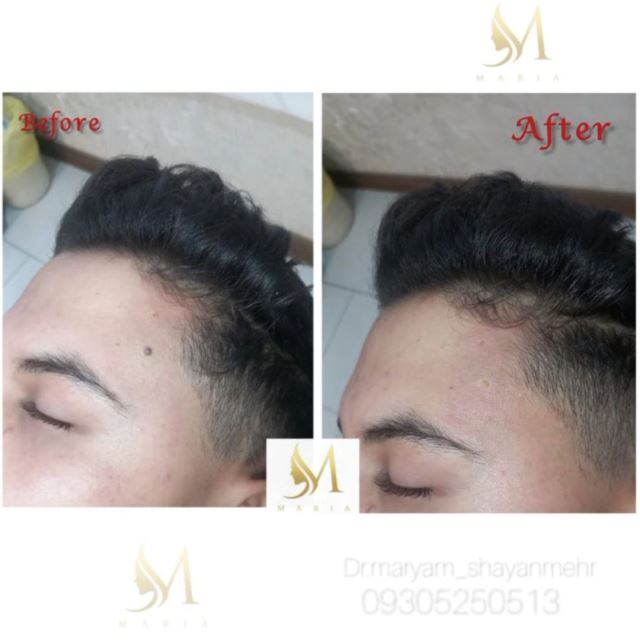 برداشتن خال و زگیل