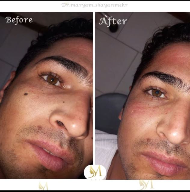 برداشتن خال و زگیل