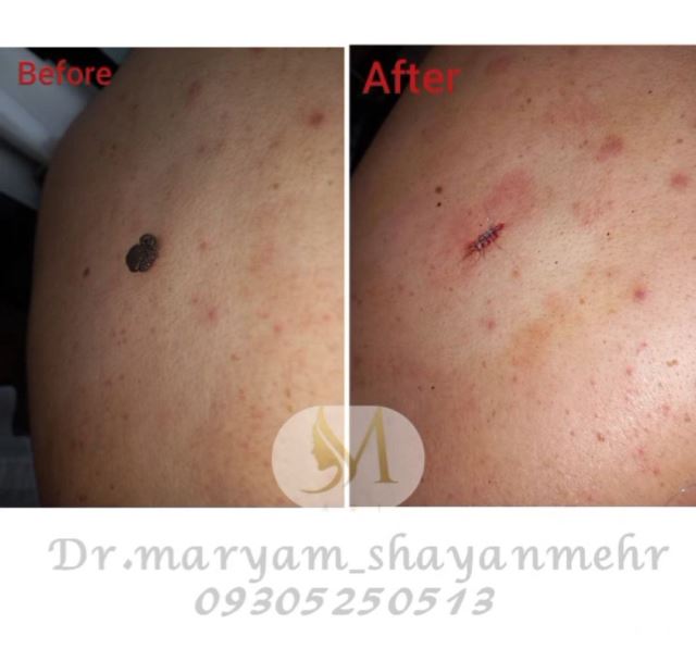 برداشتن خال و زگیل