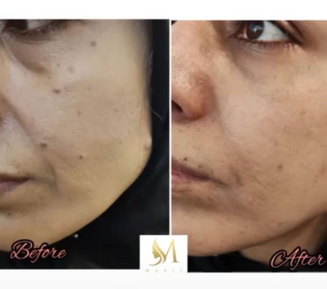 برداشتن خال و زگیل