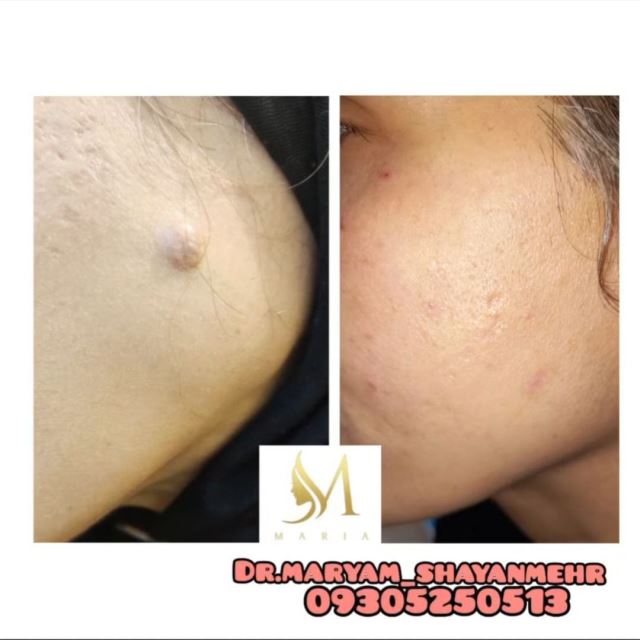 برداشتن خال و زگیل