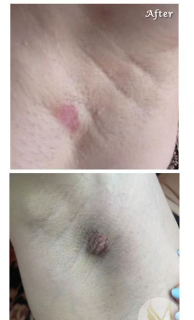 برداشتن خال و زگیل