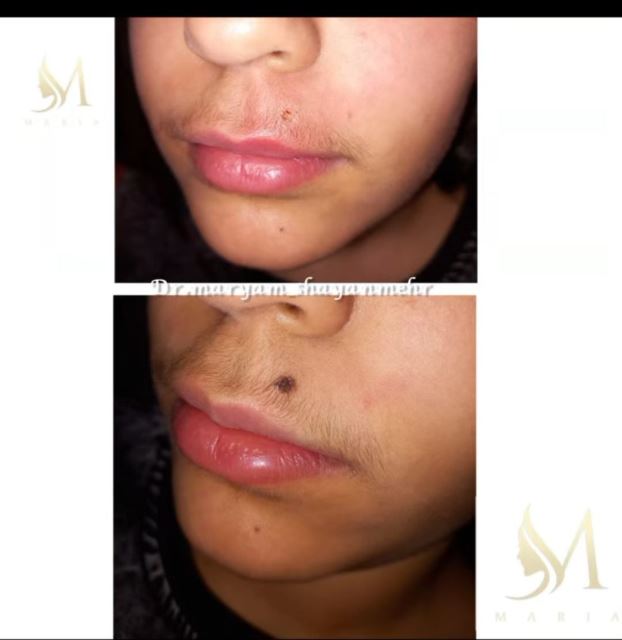 برداشتن خال و زگیل