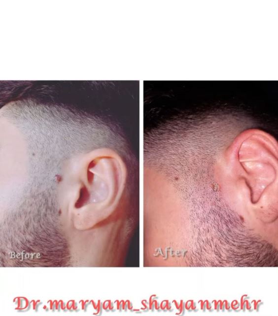 برداشتن خال و زگیل