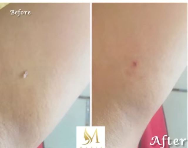 برداشتن خال و زگیل