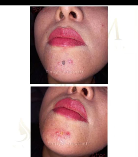 برداشتن خال و زگیل