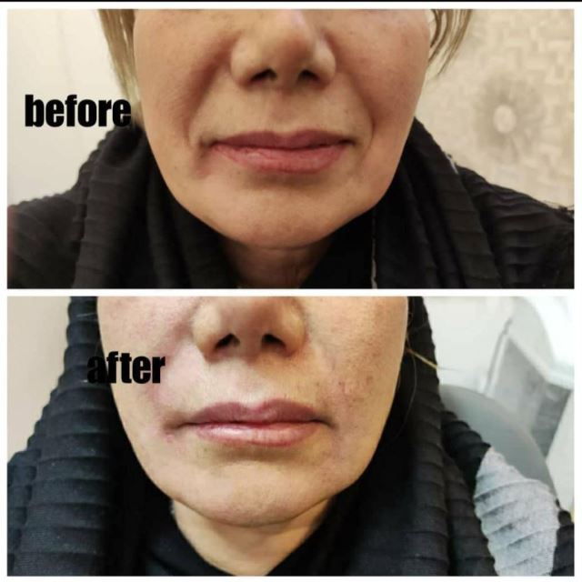 تزریق فیلر خط خنده