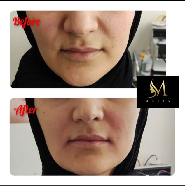 تزریق فیلر خط خنده