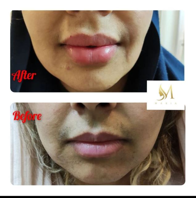 تزریق فیلر خط خنده