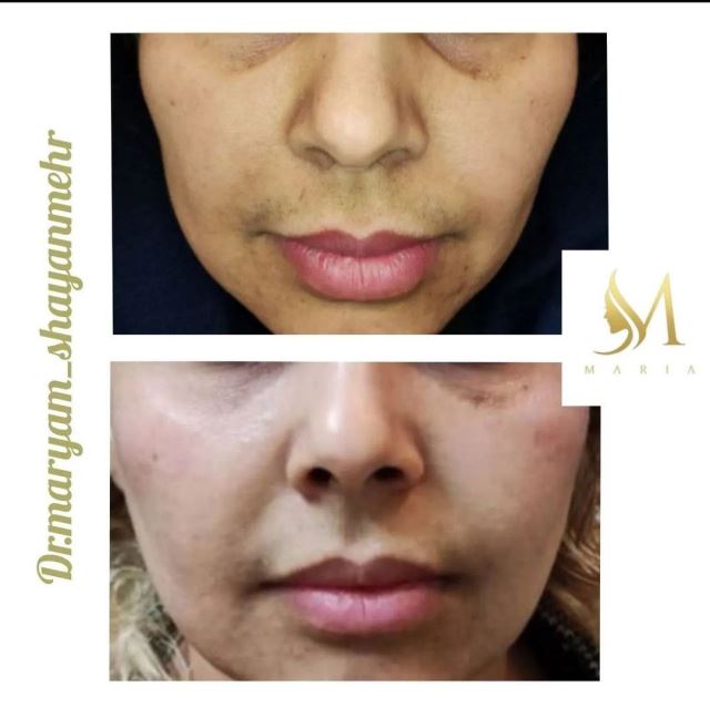 تزریق فیلر خط خنده