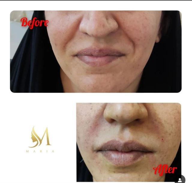 تزریق فیلر خط خنده