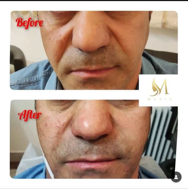 تزریق فیلر خط خنده