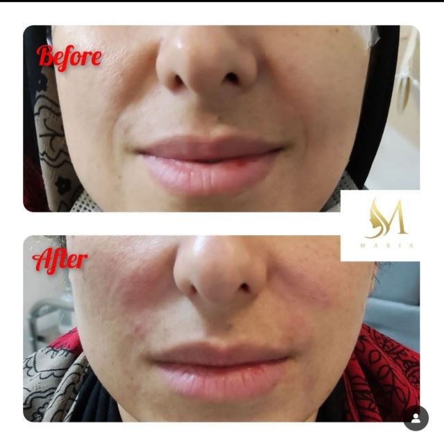 تزریق فیلر خط خنده