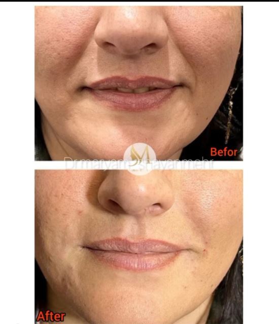 تزریق فیلر خط خنده