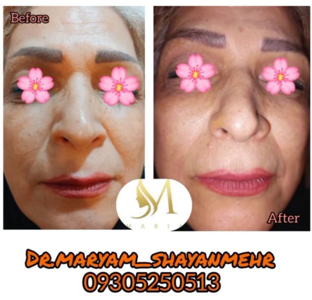 تزریق فیلر خط خنده