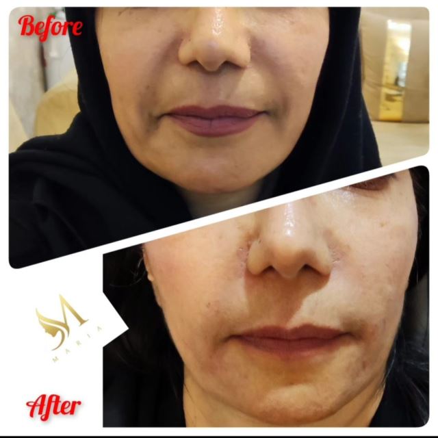 تزریق فیلر خط خنده