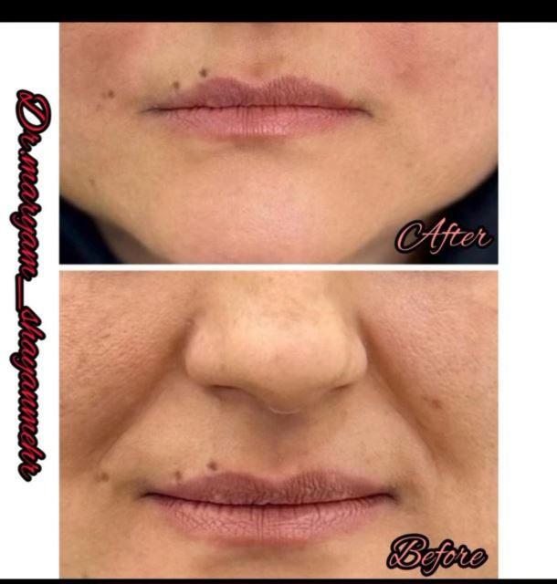 تزریق فیلر خط خنده