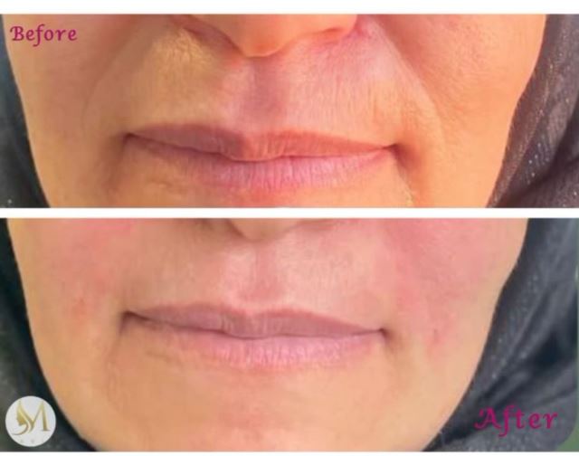 تزریق فیلر خط خنده