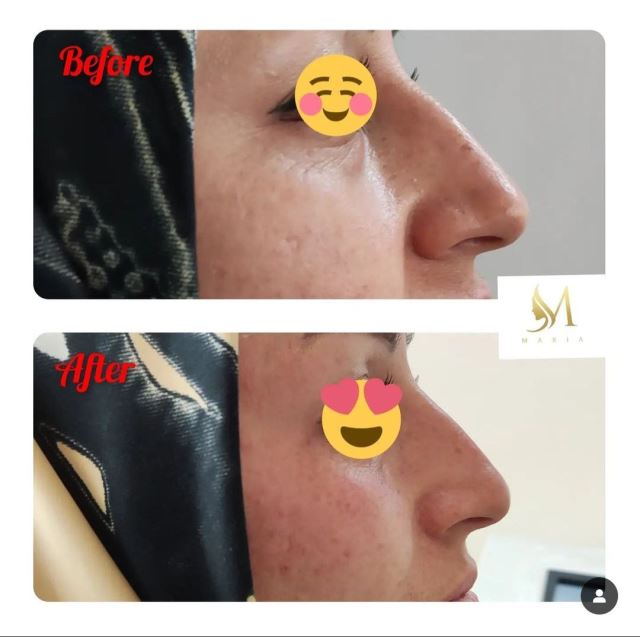 رفع نواقص بینی با تزریق فیلر