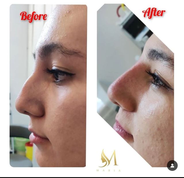 رفع نواقص بینی با تزریق فیلر