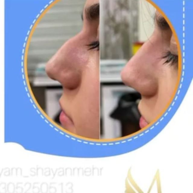 رفع نواقص بینی با تزریق فیلر