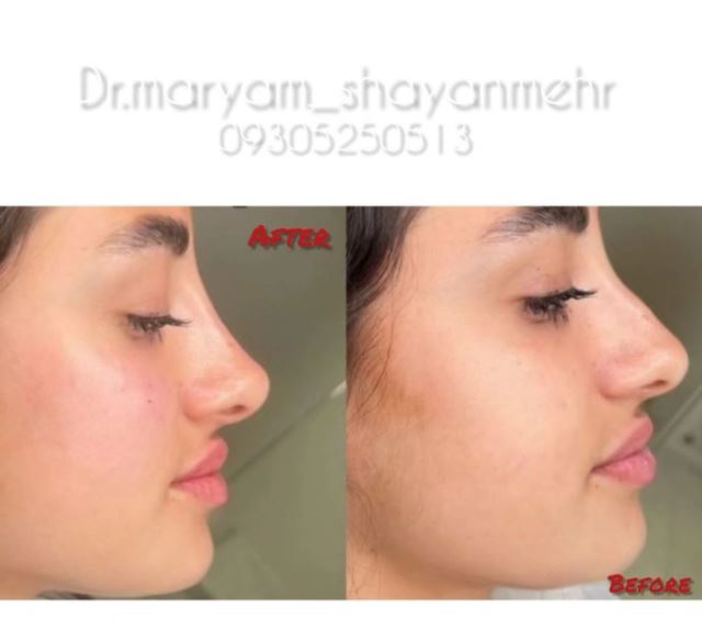رفع نواقص بینی با تزریق فیلر