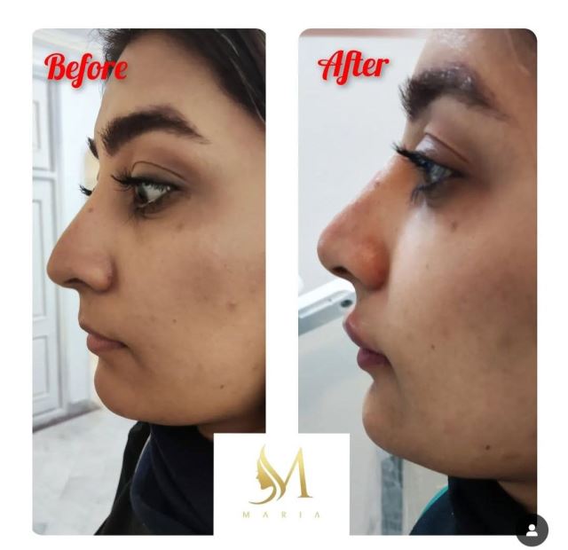 رفع نواقص بینی با تزریق فیلر