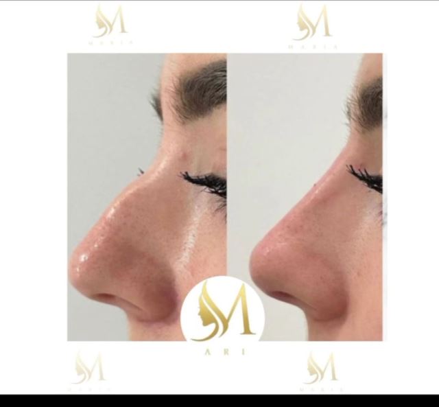 رفع نواقص بینی با تزریق فیلر