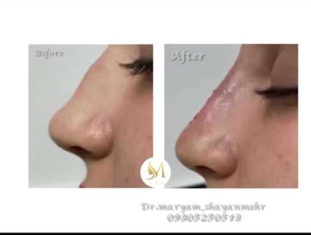 رفع نواقص بینی با تزریق فیلر