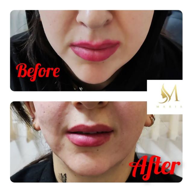 کانتورینگ وزاویه سازی فک