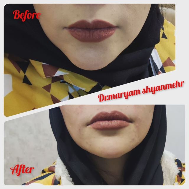 کانتورینگ وزاویه سازی فک