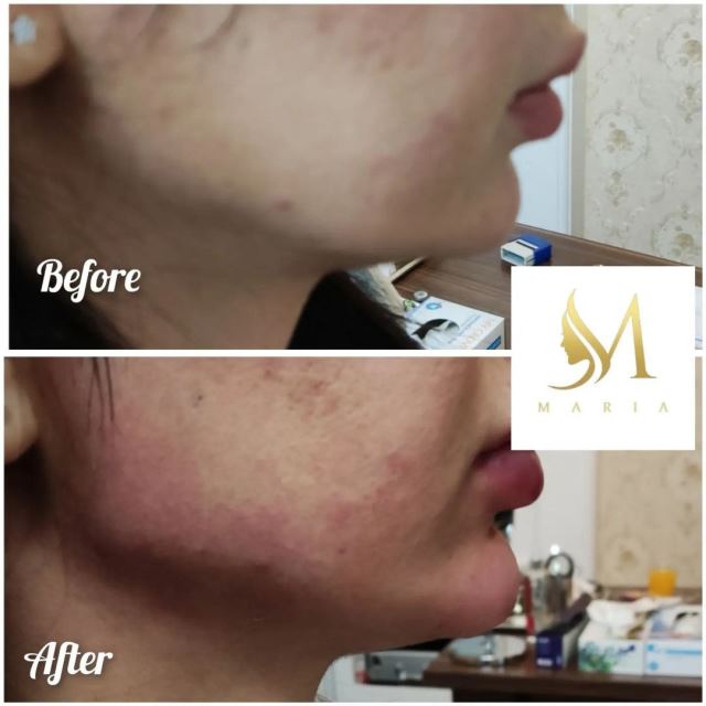 کانتورینگ وزاویه سازی فک