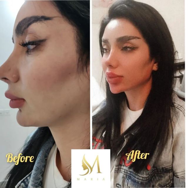 کانتورینگ وزاویه سازی فک