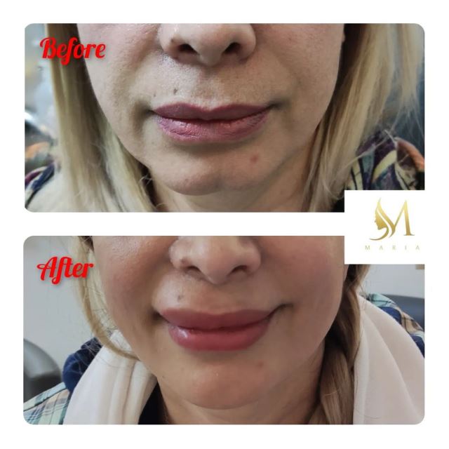 کانتورینگ وزاویه سازی فک