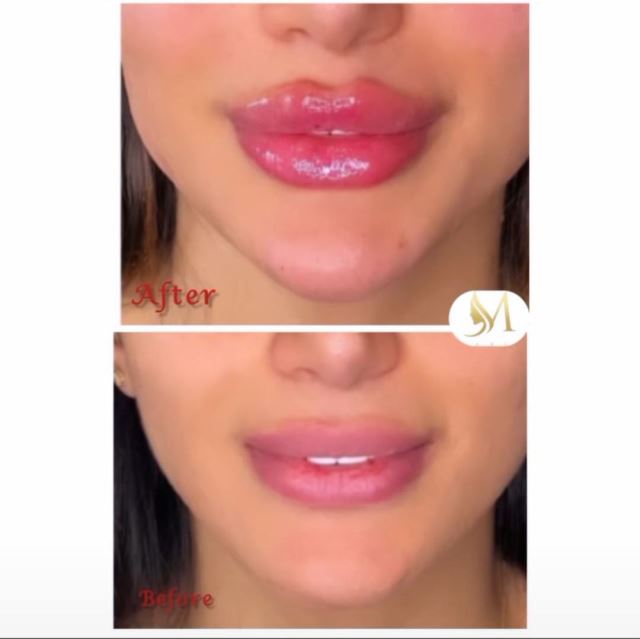 کانتورینگ وزاویه سازی فک