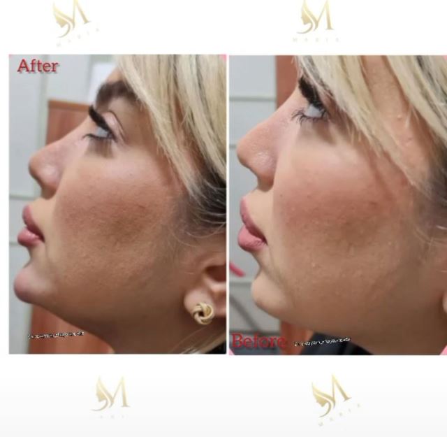 کانتورینگ وزاویه سازی فک