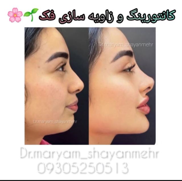 کانتورینگ وزاویه سازی فک