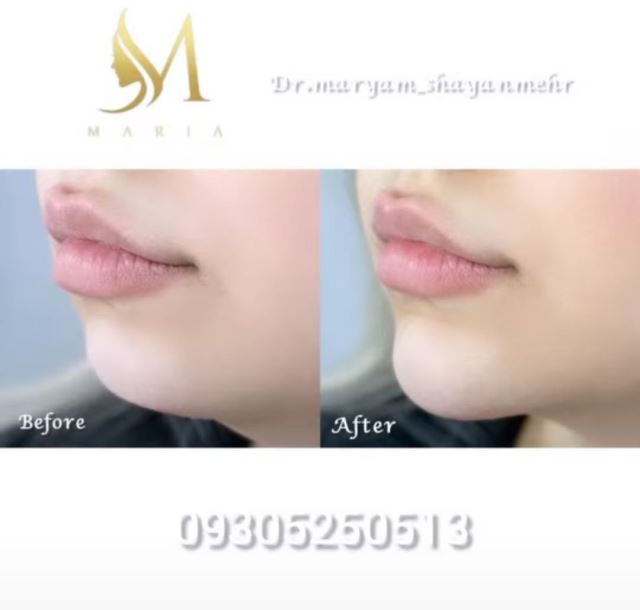 کانتورینگ وزاویه سازی فک