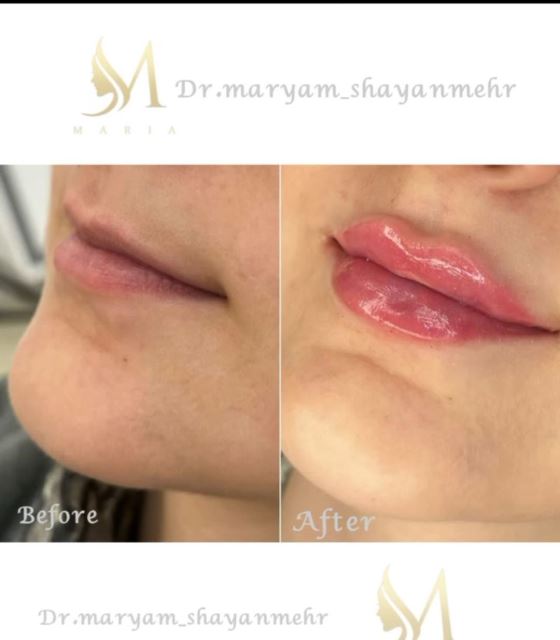 کانتورینگ وزاویه سازی فک