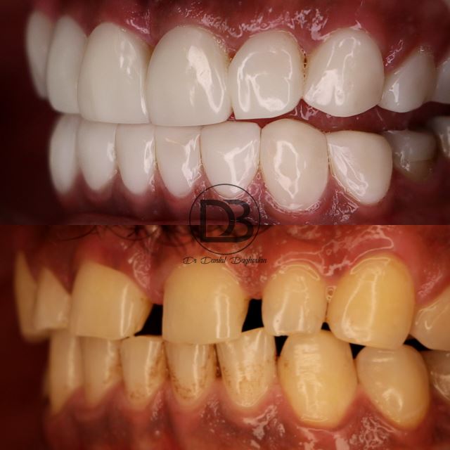 لمینت در شهرکرد