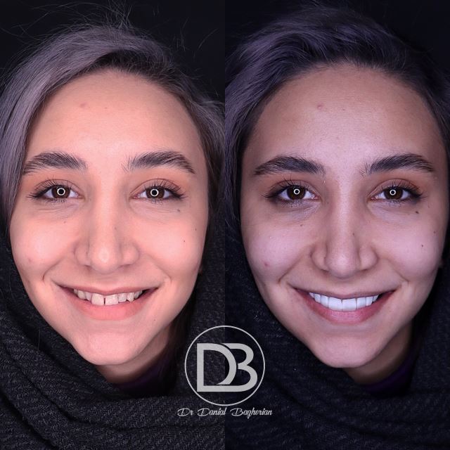 اصلاح طرح لبخند در شهرکرد