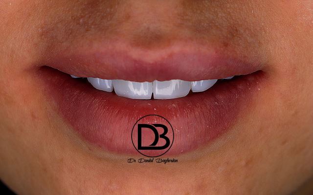 لمینت دندان در شاهین شهر