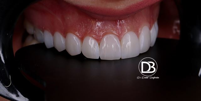 کامپوزیت قسطی در اصفهان